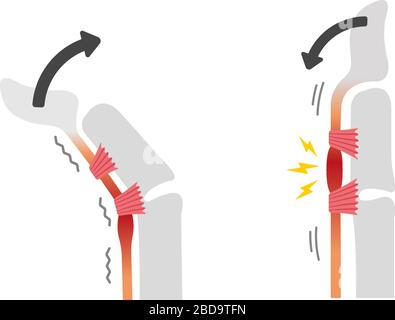 Trigger finger causes and symptoms illustration / no text Stock Vector