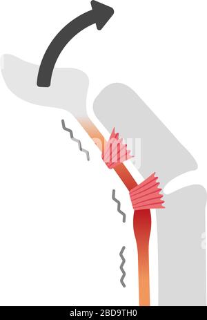 Trigger finger causes and symptoms illustration / no text Stock Vector