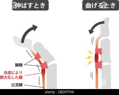 Trigger finger causes and symptoms illustration / Japanese Stock Vector