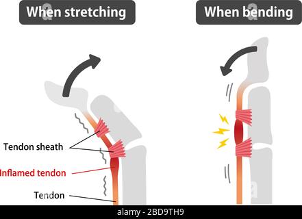 Trigger finger causes and symptoms illustration / English Stock Vector