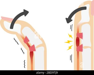 Trigger finger causes and symptoms illustration / no text Stock Vector