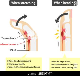 Trigger finger causes and symptoms illustration / English (with explanation texts) Stock Vector