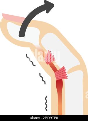 Trigger finger causes and symptoms illustration / no text Stock Vector