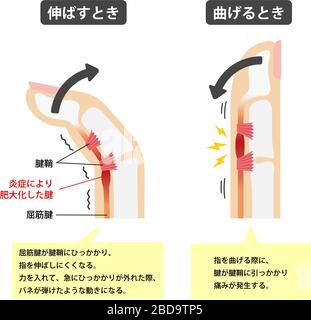 Trigger finger causes and symptoms illustration / Japanese  (with explanation texts) Stock Vector