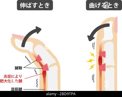 Trigger finger causes and symptoms illustration / Japanese Stock Vector