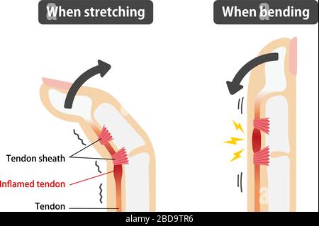 Trigger finger causes and symptoms illustration / English Stock Vector