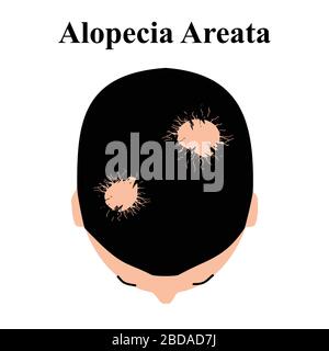 illustration of alopecia areata on the male chin Stock Vector Image ...