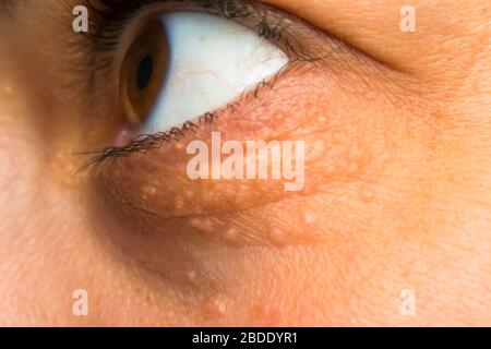 close-up photo of a women face with fat points near eye Stock Photo