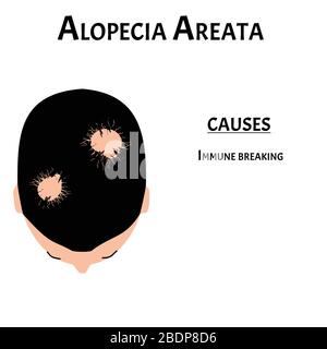 illustration of alopecia areata on the male chin Stock Vector Image ...