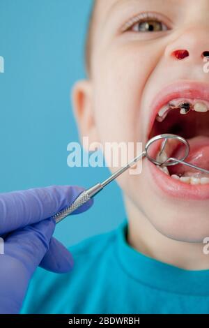 Close up of dentist's hands with assistant in blue gloves are treating teeth to a child, patient's face is closed Stock Photo