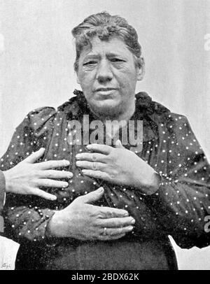 Acromegaly, 1899 Stock Photo