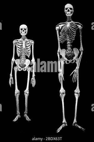 Skeletons, Normal and the American Giant, 1898 Stock Photo