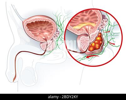 Medically Illustration showing healthy prostate gland and prostate cancer, Stock Photo