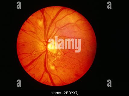 Opthalmoscope Image of Normal Retina Stock Photo