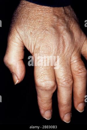 Rheumatoid Arthritis Stock Photo