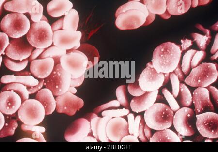 Colored scanning electron micrograph (SEM) of human red blood cells (erythrocytes). Red blood cells are biconcave, giving them a large surface area for gas exchange, and highly elastic, enabling them to pass through narrow capillary vessels. The nucleus and other organelles are lost as the cells mature. The cell's interior is packed with hemoglobin, a red iron-containing pigment that has an oxygen-carrying capacity. The main function of red blood cells is to distribute oxygen to body tissues and to carry waste carbon dioxide back to the lungs. Stock Photo