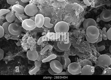 This scanning electron micrograph (SEM) depicted a number of red blood cells found enmeshed in a fibrinous matrix on the luminal surface of an indwelling vascular; Magnified 2849x. In this instance, the indwelling catheter was a tube that was left in place creating a patent portal directly into a blood vessel. Note the biconcave cytomorphologic shape of each erythrocyte, which increases the surface area of these hemoglobin-filled cells, thereby, promoting a greater degree of gas exchange, which is their primary function in an in vivo setting. In their adult phase, these cells possess no nucleu Stock Photo