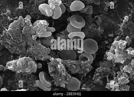 This scanning electron micrograph (SEM) depicted a number of red blood cells found enmeshed in a fibrinous matrix on the luminal surface of an indwelling vascular catheter; Magnified 2858x Note the biconcave cytomorphologic shape of each erythrocyte, which increases the surface area of these hemoglobin-filled cells, thereby, promoting a greater degree of gas exchange, which is their primary function in an in vivo setting. In their adult phase, these cells possess no nucleus. What appears to be irregularly-shaped chunks of debris, are actually fibrin clumps, which when inside the living organis