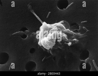 #6 in a six-step sequence of the death of a cancer cell. A cancer cell has migrated through the holes of a matrix coated membrane from the top to the bottom, simulating natural migration of a invading cancer cell between, and sometimes through, the vascular endothelium. Notice the spikes or pseudopodia that are characteristic of an invading cancer cell (1). A buffy coat containing red blood cells, lymphocytes and macrophages is added to the bottom of the membrane. A group of macrophages identify the cancer cell as foreign matter and start to stick to the cancer cell, which still has its spikes Stock Photo