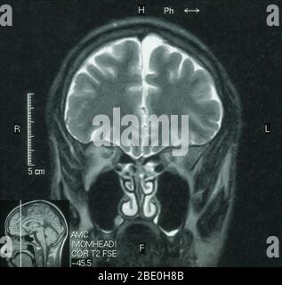 MRI of the brain (sagittal view) of a 26 year old male. The MRI was taken as a result of head injury in a car accident. Diagnosis from the MRI's is a small arachnoid cyst in the parasagittal anterior left frontal region. All other aspects appear normal. Stock Photo