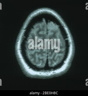 MRI scan, T2 weighted, axial view through the brain of a 54 year old female. The MRI is normal. Stock Photo