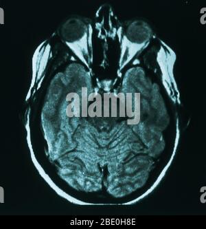 MRI scan (axial view) through the brain of a 31 year old female. The MRI is normal. Stock Photo