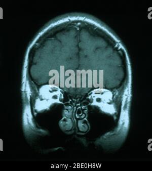 MRI scan, T1 weighted, axial view through the brain of a 54 year old female. The MRI is normal. Stock Photo