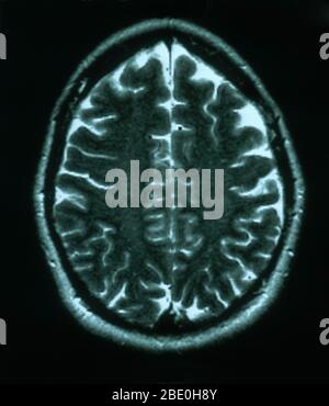 MRI scan, T2 weighted, axial view through the brain of a 54 year old female. The MRI is normal. Stock Photo