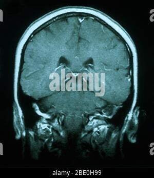 MRI scan, T1 weighted, axial view through the brain of a 54 year old female. The MRI is normal. Stock Photo