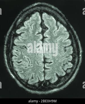 MRI of the brain (axial view) of a 26 year old male. The MRI was taken as a result of head injury in a car accident. Diagnosis from the MRI's is a small arachnoid cyst in the parasagittal anterior left frontal region. All other aspects appear normal. Stock Photo