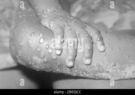 Right hand and leg of a 4-year-old girl in Bondua, Grand Gedeh County, Liberia, which reveals numerous maculopapular monkeypox lesions, enabling you to see the similarity of these lesions to those of smallpox. Monkeypox is an infectious disease caused by the monkeypox virus. Symptoms begin with fever, headache, muscle pains, swollen lymph nodes, and feeling tired. This is then followed by a rash that forms blisters and scabs over. The time from exposure to onset of symptoms is around 10 days. The duration of symptoms is typically 2 to 4 weeks.  Monkeypox may be spread from handling bush meat, Stock Photo