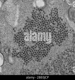 Transmission Electron Micrograph (TEM) reveals numerous, spheroid-shaped Enterovirus 68 (EV68, EV-D68, HEV68) visions which are a member of the Picornaviridae family, an enterovirus. First isolated in California in 1962 and once considered rare, it has been on a worldwide upswing in the 21st century. With some uncertainty, it has been implicated in cases of a polio-like disorder called acute flaccid myelitis. Acute flaccid myelitis (AFM) is a neurologic illness of sudden onset in children. It presents with localized limb weakness of unknown cause. Enterovirus 68, which as a member of the enter Stock Photo