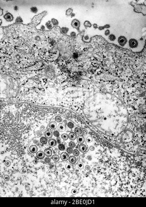 Negative stained Transmission Electron Micrograph (TEM) revealing the presence of numerous herpes simplex virions, located both inside the nucleus, and extracellularly in this tissue sample. Genital herpes is a genital infection caused by the herpes simplex virus (HSV). Most individuals carrying herpes are unaware they have been infected and many will never suffer an outbreak, which involves blisters similar to cold sores. While there is no cure for herpes, over time symptoms are increasingly mild and outbreaks are decreasingly frequent. The typical manifestation of a primary infection is clus