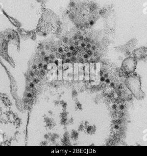 Transmission Electron Micrograph (TEM) reveals numerous, spheroid-shaped Enterovirus 68 (EV68, EV-D68, HEV68) visions which are a member of the Picornaviridae family, an enterovirus. First isolated in California in 1962 and once considered rare, it has been on a worldwide upswing in the 21st century. With some uncertainty, it has been implicated in cases of a polio-like disorder called acute flaccid myelitis. Acute flaccid myelitis (AFM) is a neurologic illness of sudden onset in children. It presents with localized limb weakness of unknown cause. Enterovirus 68, which as a member of the enter Stock Photo