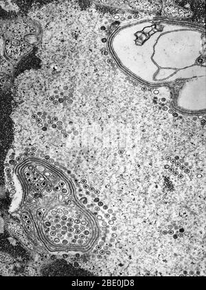 Transmission Electron Micrograph (TEM) revealing the presence of numerous herpes simplex virions, located inside a cell nucleus in this tissue sample. Genital herpes is a genital infection caused by the herpes simplex virus (HSV). Most individuals carrying herpes are unaware they have been infected and many will never suffer an outbreak, which involves blisters similar to cold sores. While there is no cure for herpes, over time symptoms are increasingly mild and outbreaks are decreasingly frequent. The typical manifestation of a primary infection is clusters of genital sores consisting of infl Stock Photo