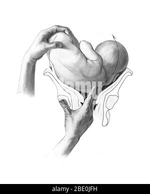 The position of the child is important for normal birthing procedure: head-first birth is preferred. Birth trauma (BT) refers to damage of the tissues and organs of a newly delivered child, often as a result of physical pressure or trauma during childbirth. The term also encompasses the long term consequences, often of a cognitive nature, of damage to the brain or cranium. Medical study of birth trauma dates to the 16th century, and the morphological consequences of mishandled delivery are described in Renaissance-era medical literature. Illustration from Grundriss zum Studium der Geburtshülfe