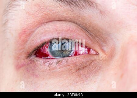 postoperative heavy inflamed eye close-up shot with selective focus and blur Stock Photo