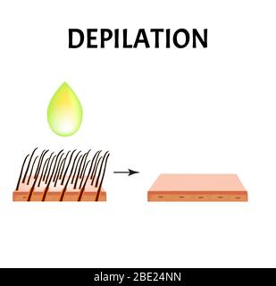 Hair depilation. Hair removal. Infographics. Vector illustration on isolated background. Stock Vector