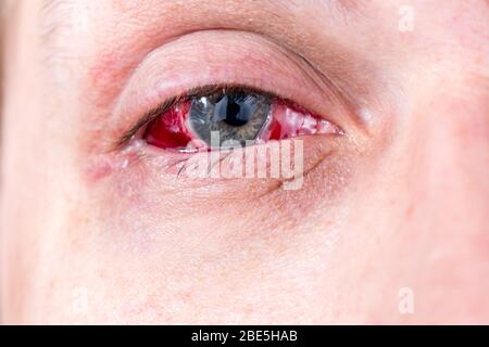 postoperative heavy inflamed eye closeup shot with selective focus and blur Stock Photo