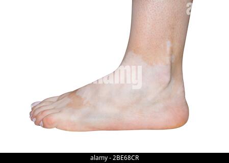 Stains from vitiligo disease on the left foot in a young Caucasian woman, isolated on a white background with a clipping path. Stock Photo