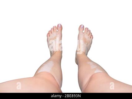 Woman with vitiligo holding pillow between legs on bed in front of