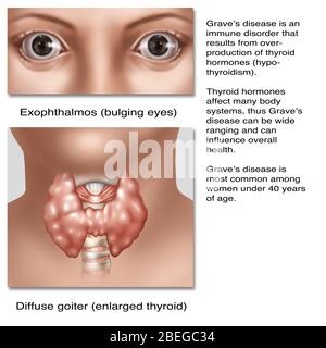 Graves disease is an immune disorder that results from over-production of thyroid hormones (hyperthyroidism). Thyroid hormones affect many body systems, thus Graves disease can be wide ranging and can influence overall health. This illustration shows two common symptom's of the disease, exophthalmos or bulging eyes and an enlarged thyroid (goiter). Graves disease is most common among women under 40 years of age. Stock Photo