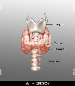 Illustration showing the location of the larynx, thyroid gland, and trachea. A malignant growth can be seen in the lower right area of the thyroid. Stock Photo