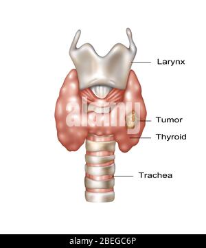 Illustration showing the location of the larynx, thyroid gland, and trachea. A malignant growth can be seen in the lower right area of the thyroid. Stock Photo