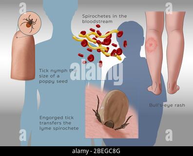 Lyme Disease Infection Cycle, Illustration Stock Photo