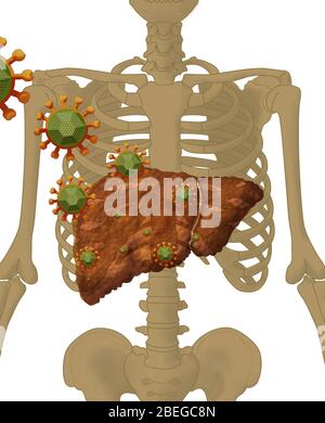 Hepatitis Virus Attacking Liver Stock Photo