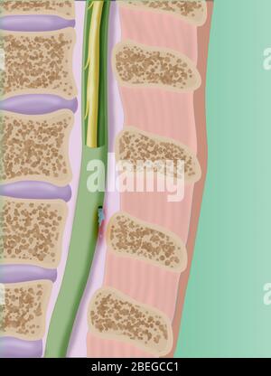 A CSF or cerebrospinal fluid leak in the dura mater of the spinal cord