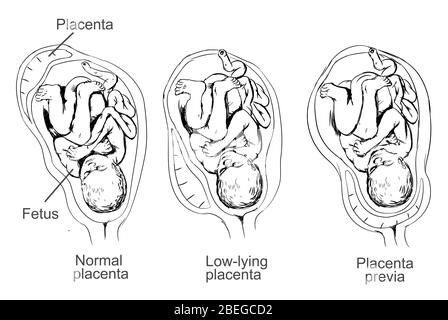 Illustration of placenta previa, a condition in which the placenta lies low in the uterus and covers the cervix, causing pregnancy complications. Stock Photo