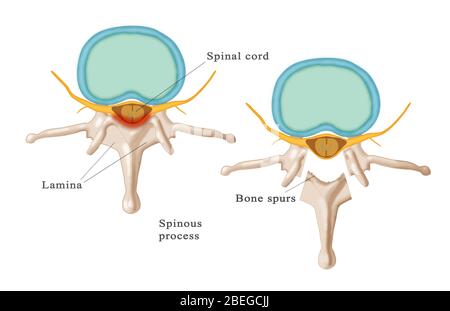 Laminectomy, Illustration Stock Photo - Alamy