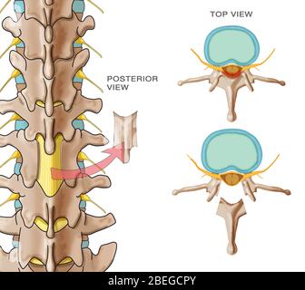 Laminectomy, Illustration Stock Photo - Alamy